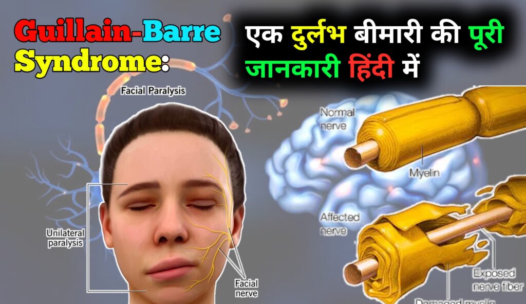Guillain-Barre Syndrome (GBS) क्या है? एक दुर्लभ बीमारी की पूरी जानकारी हिंदी में